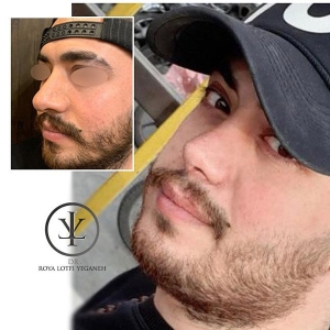 جراحی-بینی-13