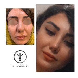 جراحی-بینی-17