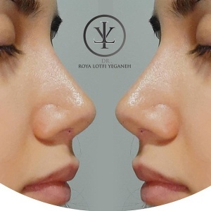 جراحی-بینی-20