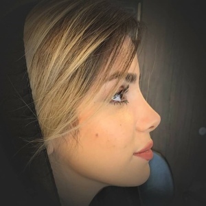 جراحی-بینی-26