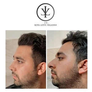 جراحی-بینی-7