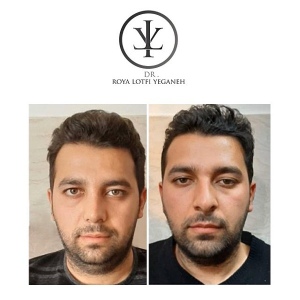 جراحی-بینی-8