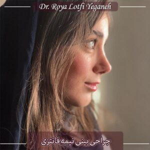 جراحی بینی نیمه فانتزی - دکتر رویا لطفی یگانه
