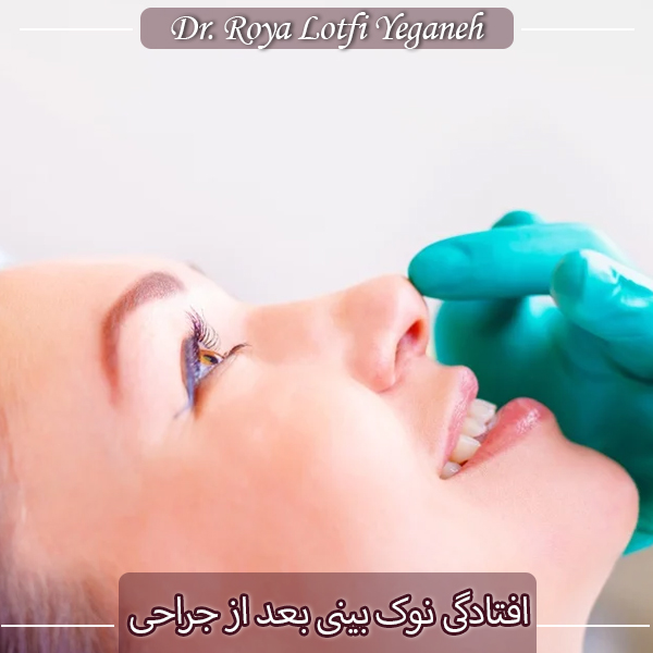 افتادگی نوک بینی بعد از جراحی - دکتر رویا لطفی یگانه