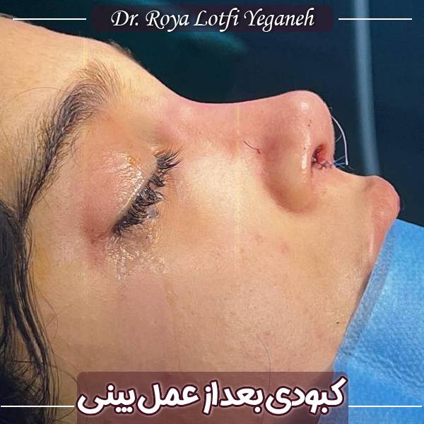 عکس کبودی زیر چشم بعد از عمل بینی