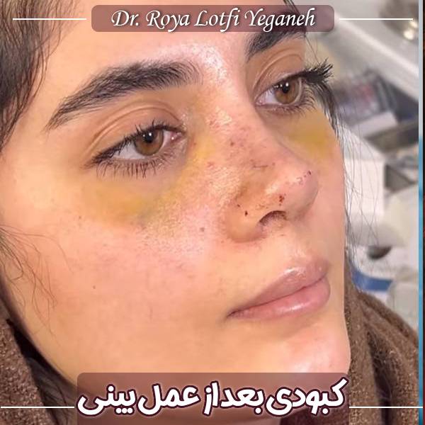 عکس کبودی صورت بعد از عمل بینی