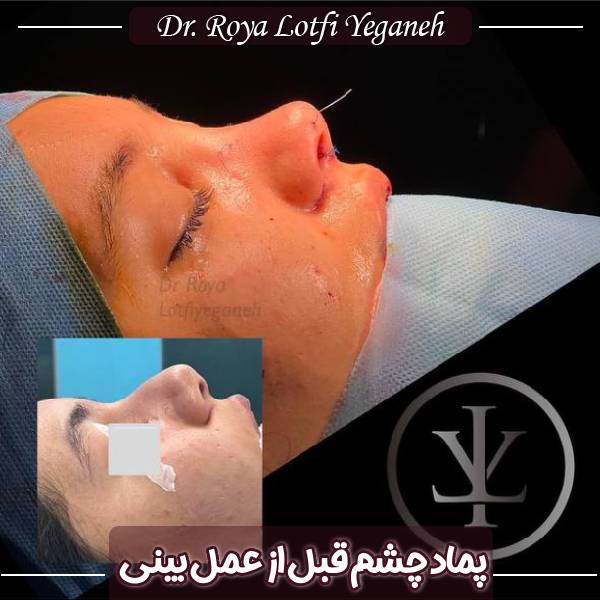 پماد چشم قبل از عمل بینی