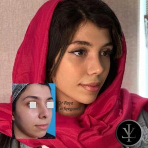 عکس جراحی بینی