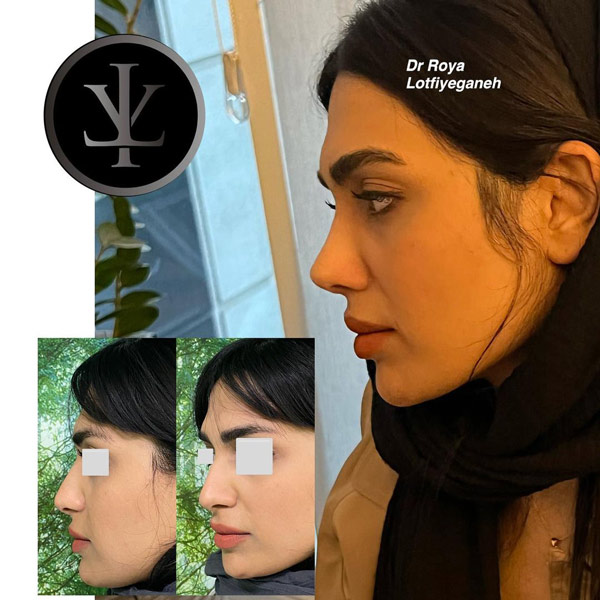 عکس جراحی بینی