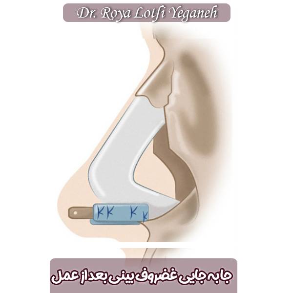 جا به جایی غضروف بینی بعد از عمل