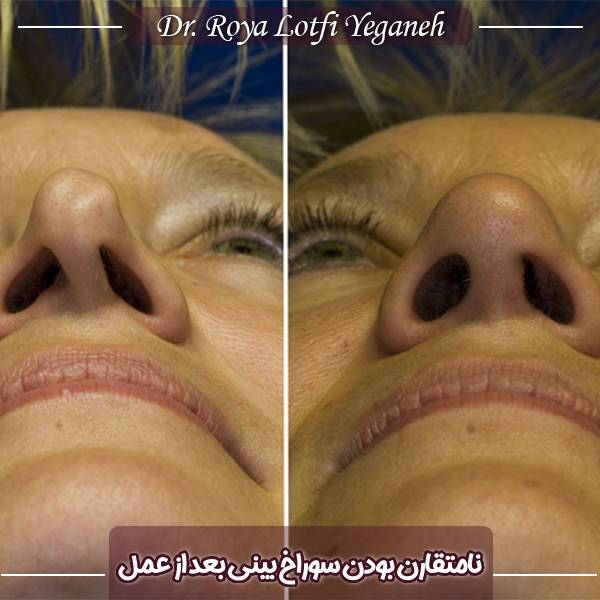 نامتقارنی سوراخ های بینی بعد از عمل