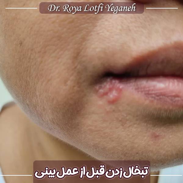 تبخال قبل از عمل بینی