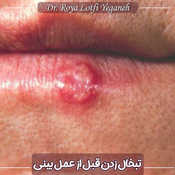 تبخال قبل از جراحی بینی