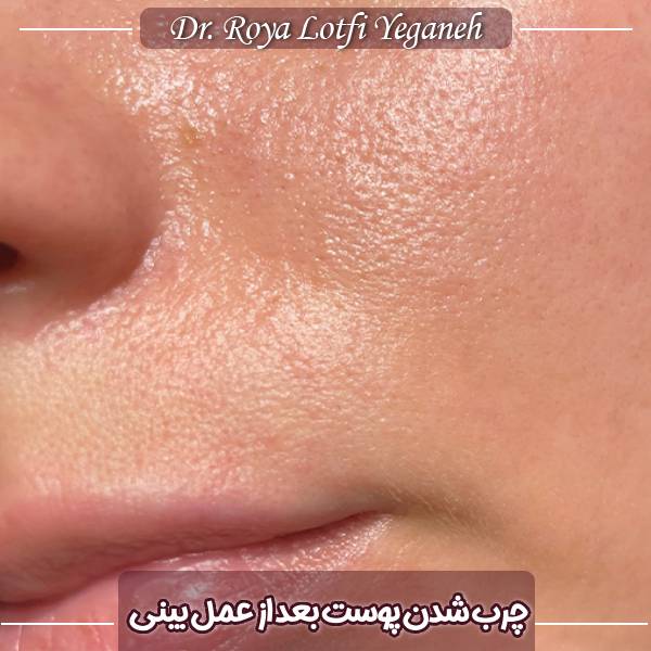 چرب شدن پوست بعد از جراحی بینی